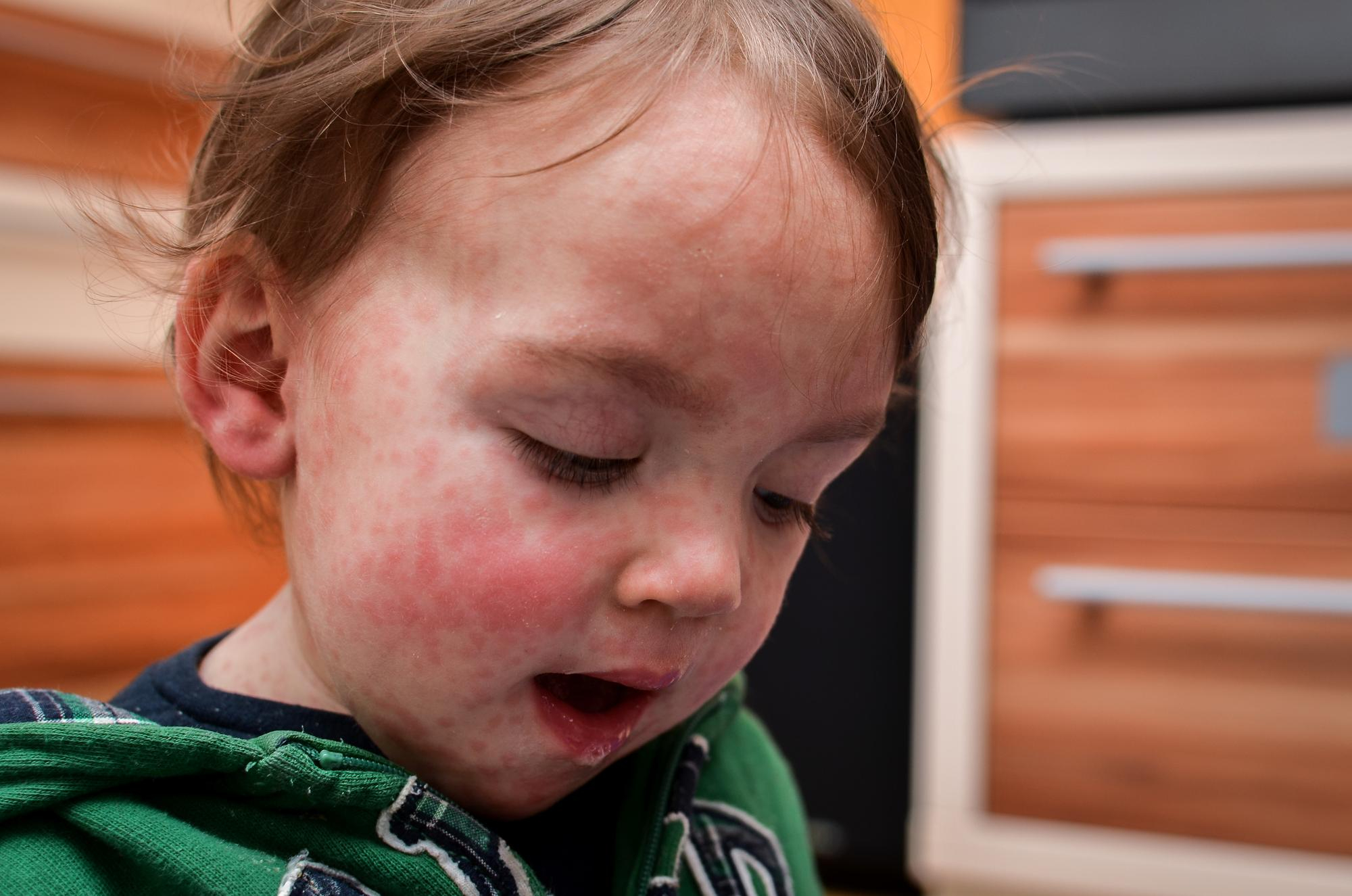 Kawasaki disease, Kawasaki disease with macrophage activation syndrome