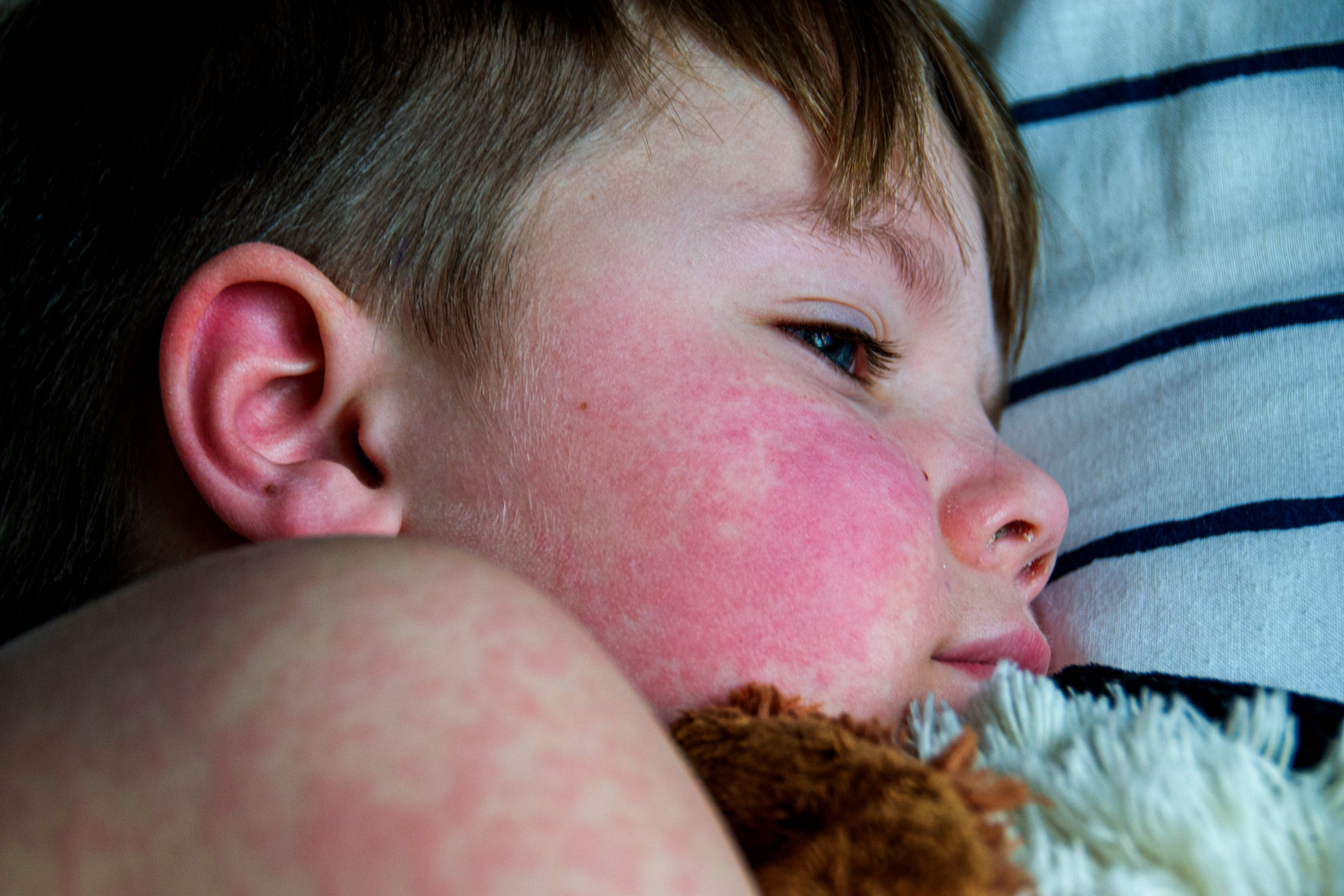 Typical inflammatory CTD (iCTD) presentation – SLE and others, JDM